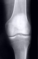 Knee Xray
