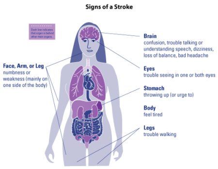 Signs of a Stroke
